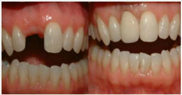 Incredible Discovery: Say Goodbye To The Dental Implants, Grow Your Own Teeth In 9 Weeks - picture 2
