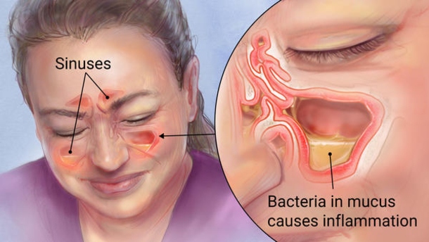 Kill Sinus Infection Within Minutes, With What You Have In Your Kitchen! - picture 2