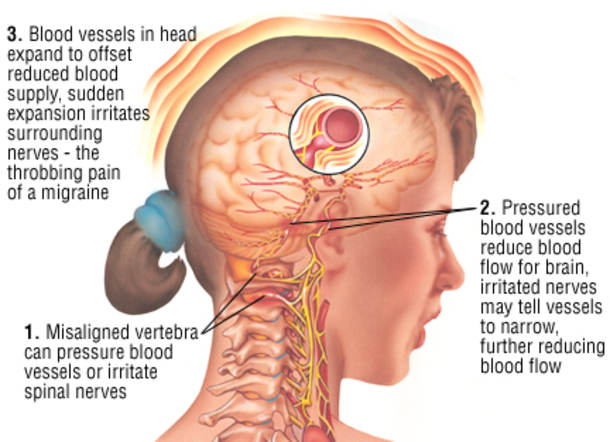 Learn The Different Types Of Dangerous And Serious Headaches... - picture 2