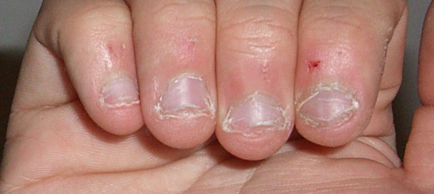 Man Dies From Severe Nail Biting Habit; Doctor Issues Warning To Others... - picture 2