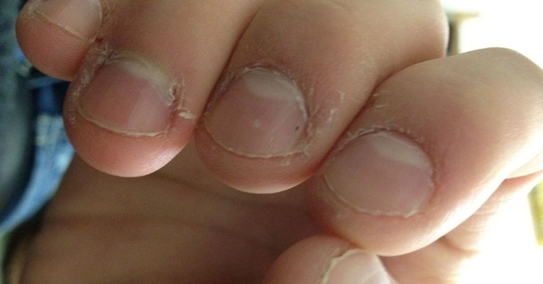Man Nearly Dies After Getting Sick From Biting His Nails - picture 2