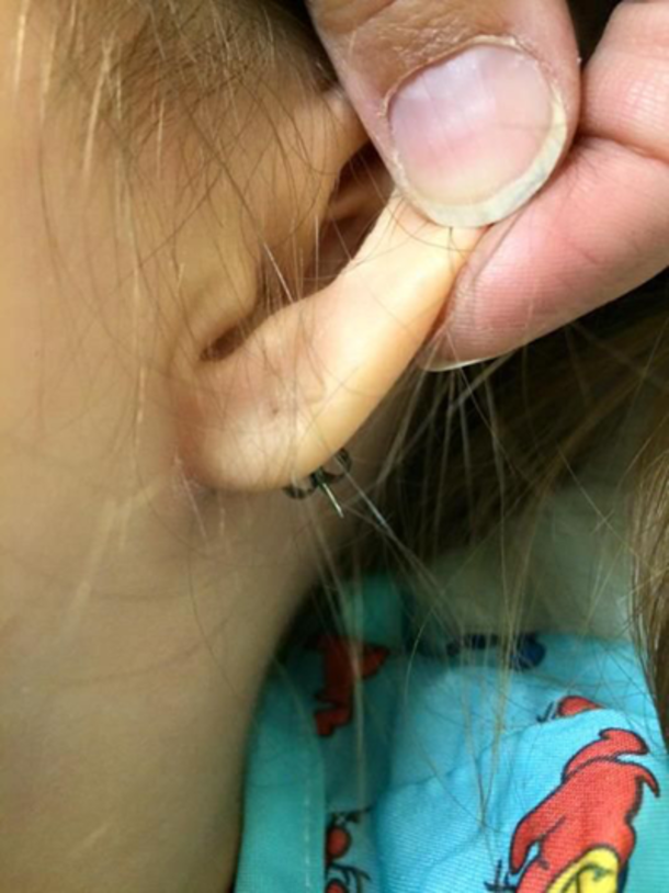 Mom Sees Her Young Daughter's Earring Fall Out. Moments Later? They're Rushing To The Hospital. - picture 2
