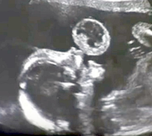 Mom Sees Unborn Baby ‘Blowing Bubble’ During Ultrasound, Doctor Urges Her To Abort Immediately - picture 3