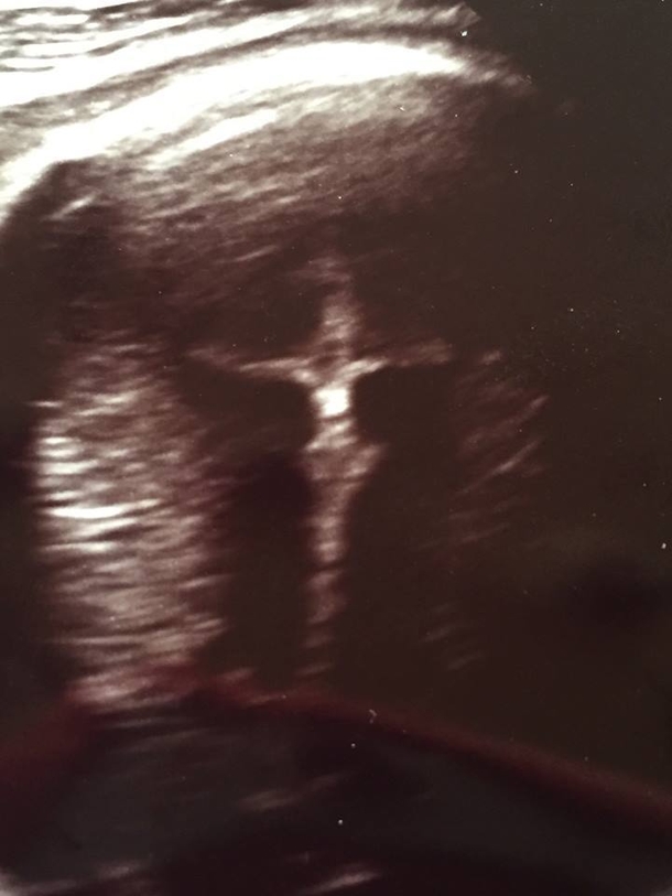 Mom-To-Be Goes In For Ultrasound Of Baby, Stunned By What Else It Caught - picture 2
