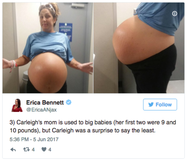 Mom-To-Be Is Stunned By The Size Of Her Belly, But Doctors Are Blown Away On Delivery Day - picture 2