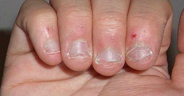 Nail Biting Is A Sign Of This Personality Trait - picture 2