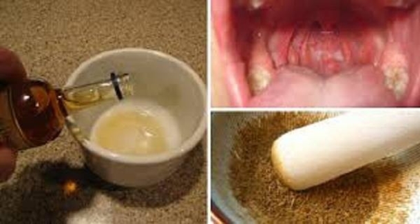 Natural Ingredient For Cure Tonsillitis And Sore Throat - picture 2