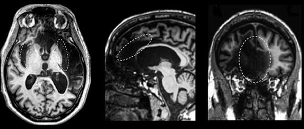 New Study Reveals That Forgetfulness May Actually Be A Sign Of Superior Intelligence - picture 2