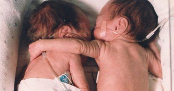Newborn Twin Wraps Her Arm Around Dying Sibling, Then A Miracle Occurs - picture 2