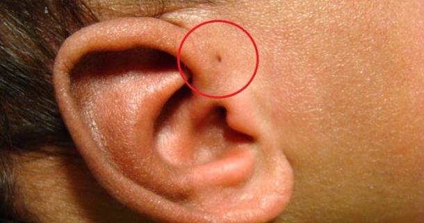 Only A Few People In The World Have This Tiny Hole, Here’s Why… - picture 2