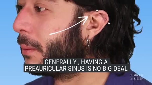 Only A Few People In The World Have This Tiny Hole, Here’s Why… - picture 4