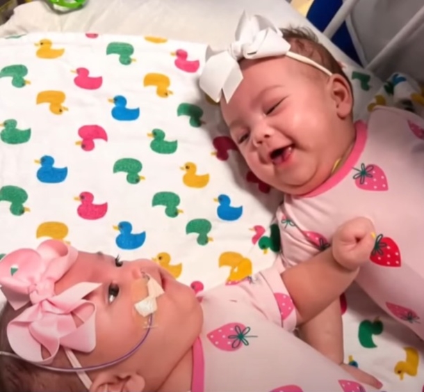 Parents Finally Hold Separated Conjoined Twins For The 1st Time After A Tough And Emotional 134 Days. - picture 5