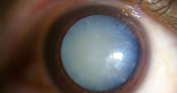 Powerful Eye Drops Removes Cataracts In No Time - A Scientific Discovery! - picture 2