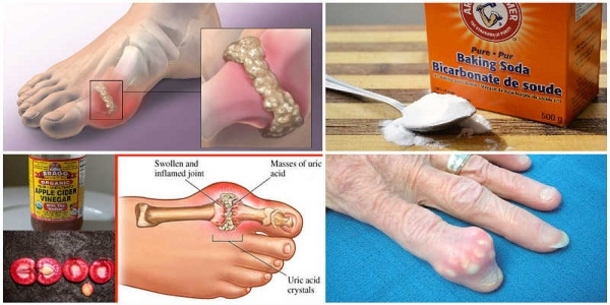 Prevent Gout and Joint Pain by Removing Uric Acid Crystallization From Your Body. Here is How - picture 2
