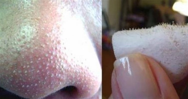 Remove Annoying Blackheads In An Instant With This One Simple Trick - picture 2