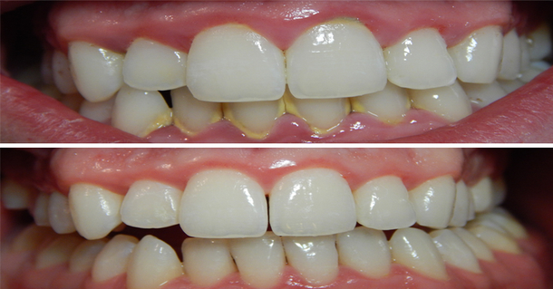 Remove Tartar And Build Up In Your Mouth With These Simple & Easy Tips - picture 2