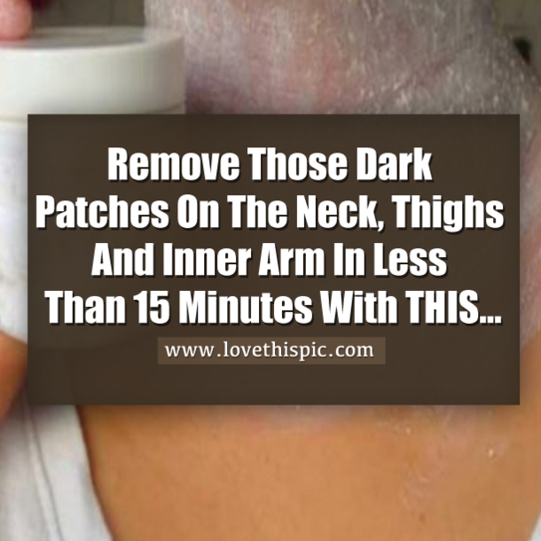 Remove Those Dark Patches On The Neck, Thighs And Inner Arm In Less Than 15 Minutes With THIS...