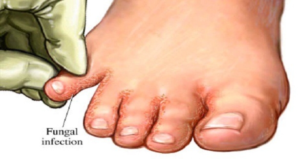 Say Goodbye To Fungal Infections: Soak Your Feet In… - picture 2
