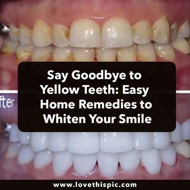 Say Goodbye to Yellow Teeth: Easy Home Remedies to Whiten Your Smile
