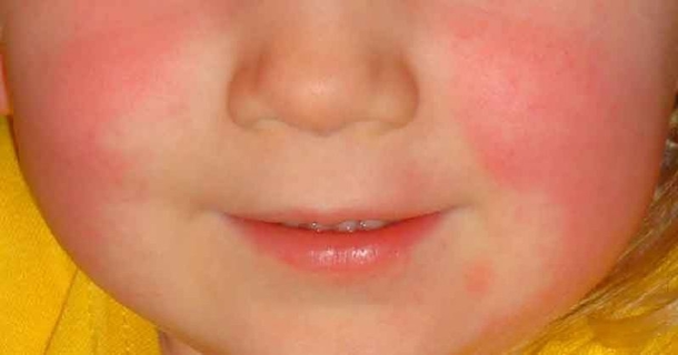 Scarlet Fever is Back and Every Parent Needs to Watch Out For These Warning Signs - picture 2
