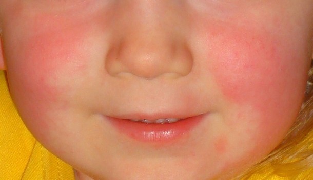Scarlet Fever Is Back And Every Parent Needs To Watch Out For These Warning Signs - picture 2