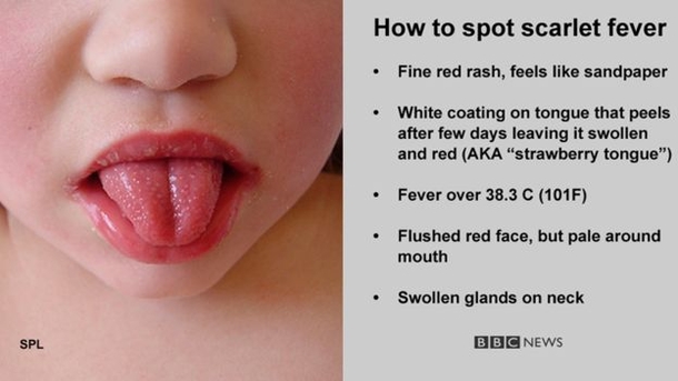 Scarlet Fever Is Back And Every Parent Needs To Watch Out For These Warning Signs - picture 3