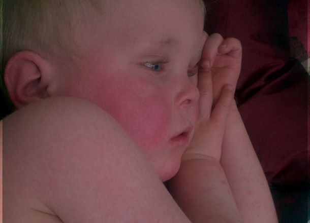 Scarlet Fever Is Back And Every Parent Needs To Watch Out For These Warning Signs - picture 5