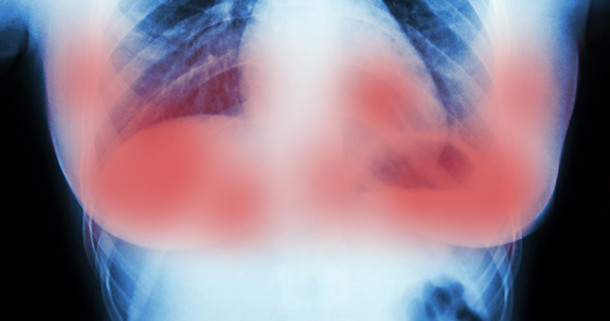 Scientists in Amsterdam Just Destroyed Breast Cancer Tumors in 11 Days Without Chemo - picture 2