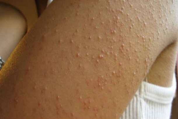 She Had Itchy Red Bumps All Over Her Skin, But Was Shocked When She Found Out It Was Because Of THIS... - picture 6
