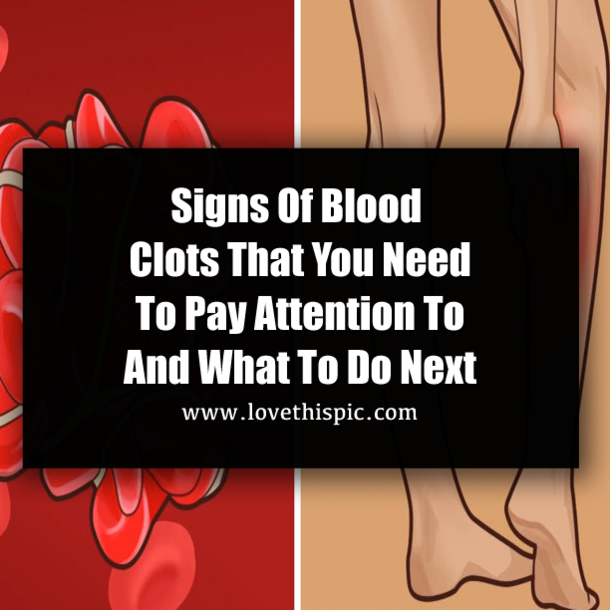 Signs Of Blood Clots That You Need To Pay Attention To And What To Do Next