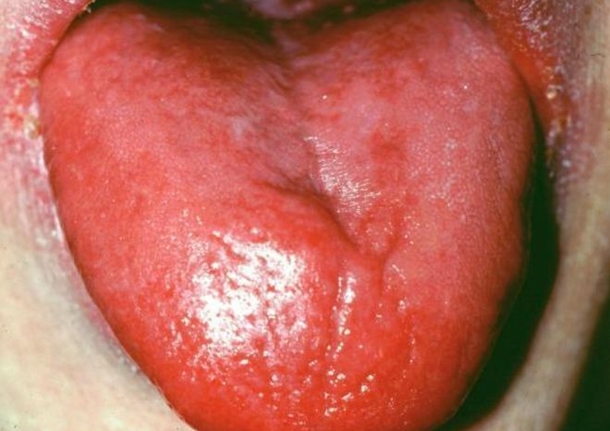 Stick Your Tongue Out; If You See These Wavy Edges, It Means This! - picture 3