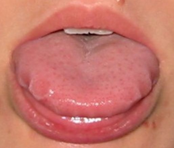 Stick Your Tongue Out; If You See These Wavy Edges, It Means This! - picture 4