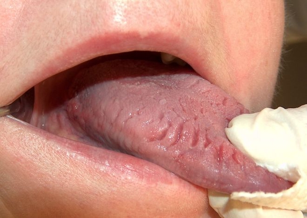 Stick Your Tongue Out; If You See These Wavy Edges, It Means This! - picture 5