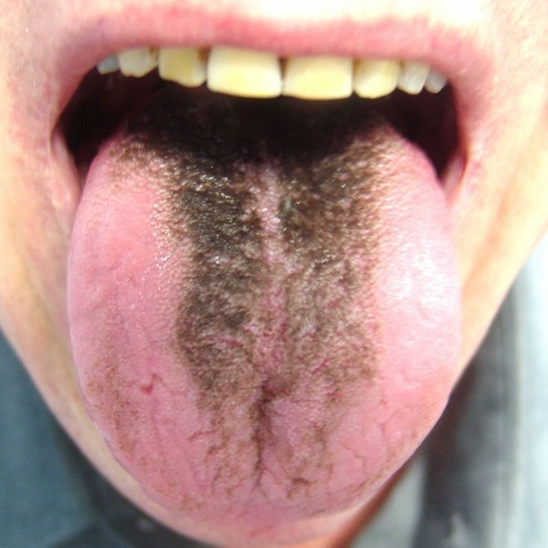 Stick Your Tongue Out; If You See These Wavy Edges, It Means This! - picture 6
