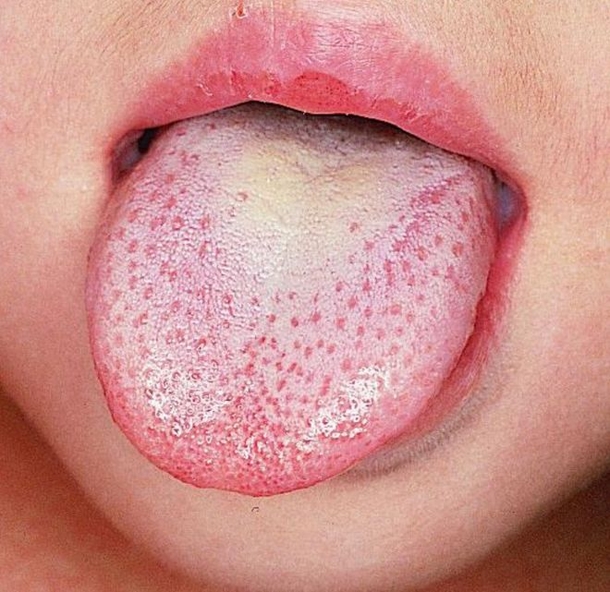 Stick Your Tongue Out; If You See These Wavy Edges, It Means This! - picture 7