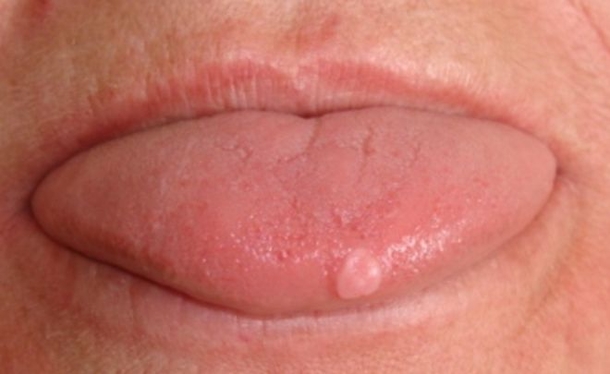 Stick Your Tongue Out; If You See These Wavy Edges, It Means This! - picture 8