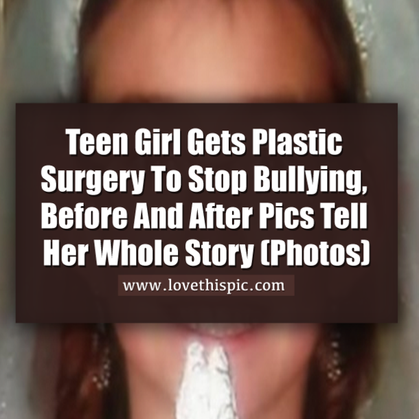 Teen Girl Gets Plastic Surgery To Stop Bullying, Before And After Pics Tell Her Whole Story (Photos)