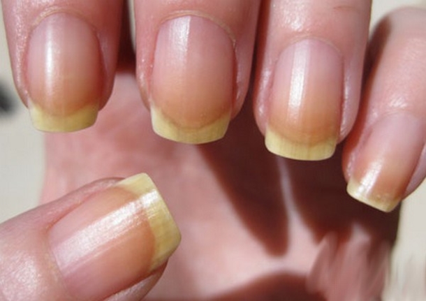 The Shape And Color Of Your Nails Say A Lot About Your Health... - picture 3