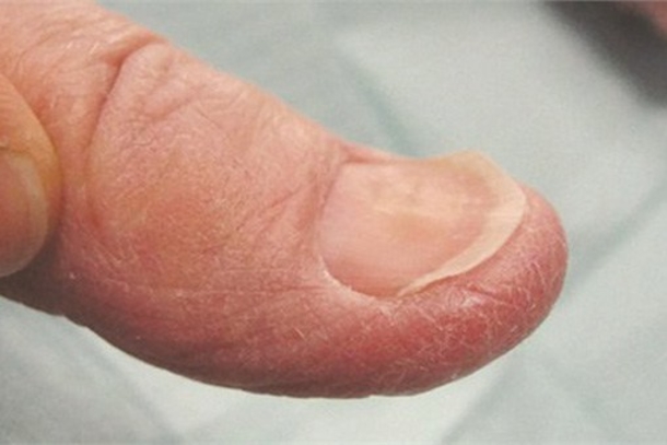 The Shape And Color Of Your Nails Say A Lot About Your Health... - picture 6
