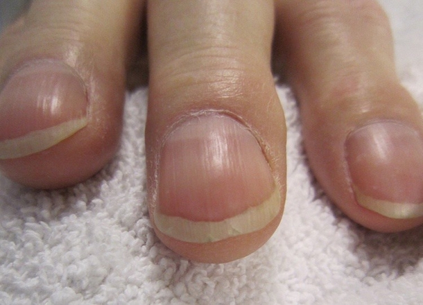 The Shape And Color Of Your Nails Say A Lot About Your Health... - picture 7