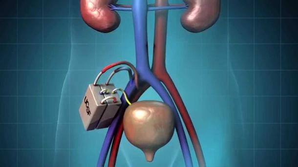 The World’s First Artificial Kidney Is Going To Replace Dialysis In The Next Few Years. This Is How It Works! - picture 2