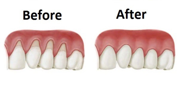 These 5 Natural Ingredients Will Help Your Receding Gums Grow Back - picture 2
