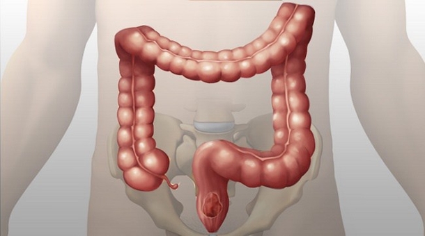 This 2 Ingredient Remedy Will Clean Your Colon Efficiently! - picture 2
