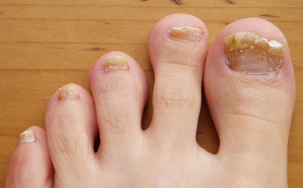 This Household Item Will Cure Toe Fungus Faster Than Any Drugs. You Won't Believe What It Is Either - picture 2