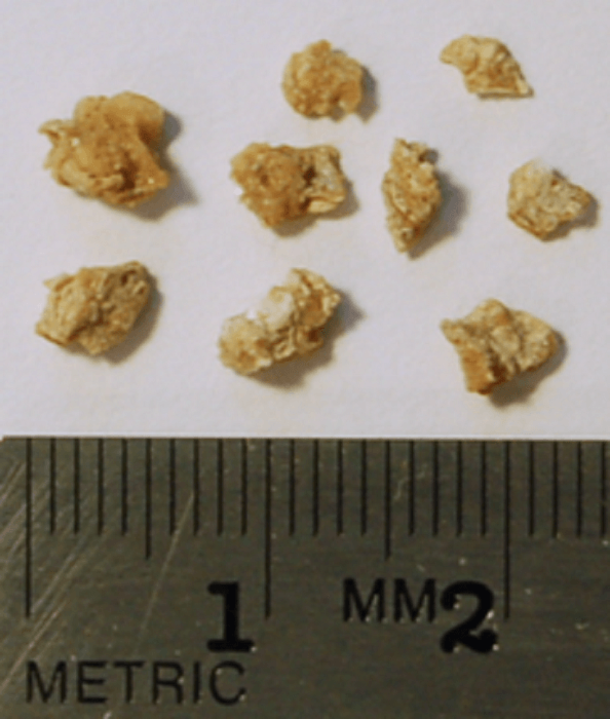 This Is How To Identify 5 Most Common Symptoms Of Kidney Stones - picture 2