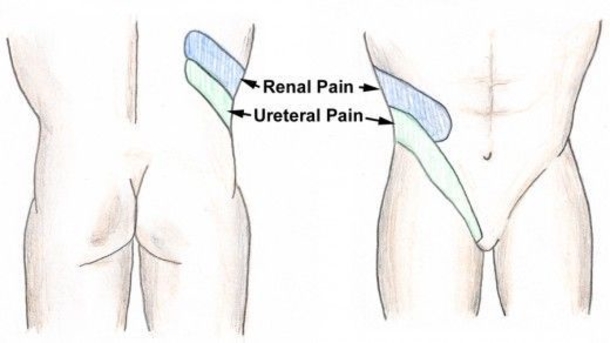 This Is How To Identify 5 Most Common Symptoms Of Kidney Stones - picture 4