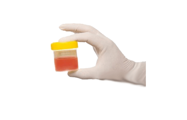 This Is How To Identify 5 Most Common Symptoms Of Kidney Stones - picture 5