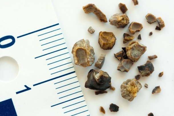 This Is How To Identify 5 Most Common Symptoms Of Kidney Stones - picture 8