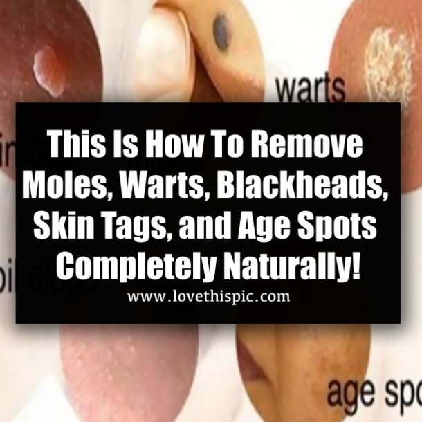 This Is How To Remove Moles, Warts, Blackheads, Skin Tags, and Age Spots Completely Naturally!