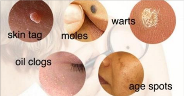 This Is How To Remove Moles, Warts, Blackheads, Skin Tags, and Age Spots Completely Naturally! - picture 2